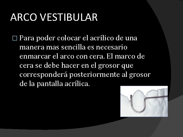 ARCO VESTIBULAR � Para poder colocar el acrílico de una manera mas sencilla es ARCO VESTIBULAR � Para poder colocar el acrílico de una manera mas sencilla es