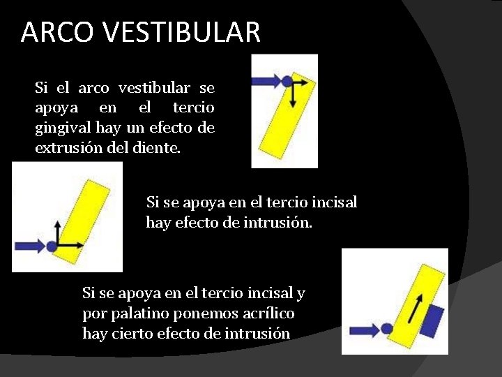 ARCO VESTIBULAR Si el arco vestibular se apoya en el tercio gingival hay un ARCO VESTIBULAR Si el arco vestibular se apoya en el tercio gingival hay un