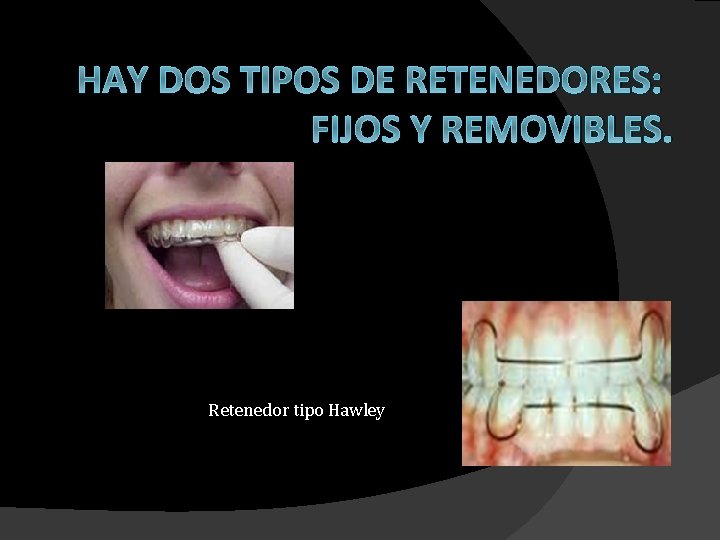 RETENEDORES EN ORTODONCIA RETENEDORES A medida que los