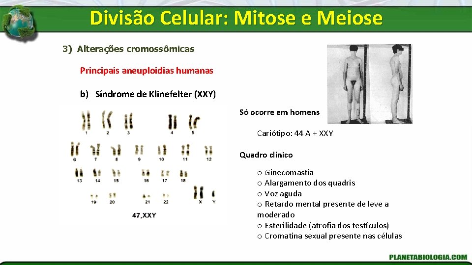 Divisão Celular: Mitose e Meiose 3) Alterações cromossômicas Principais aneuploidias humanas b) Síndrome de