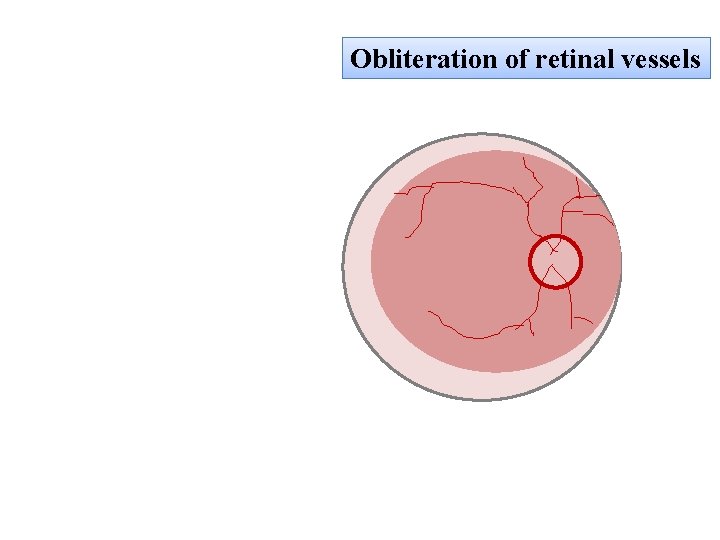 Obliteration of retinal vessels 