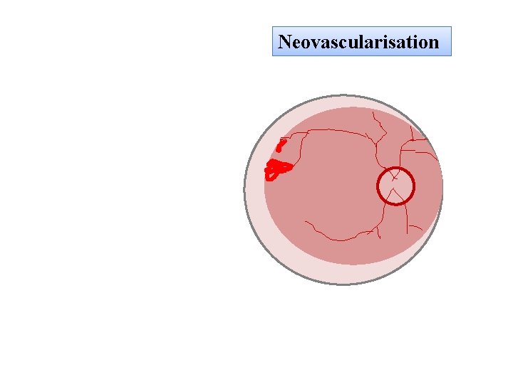 Neovascularisation 