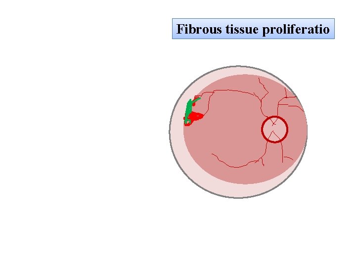 Fibrous tissue proliferatio 