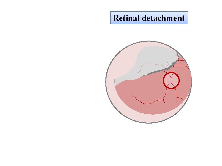 Retinal detachment 
