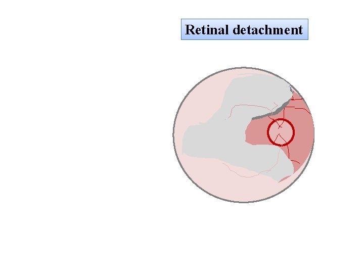 Retinal detachment 