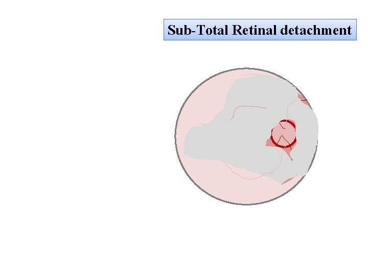 Sub-Total Retinal detachment 