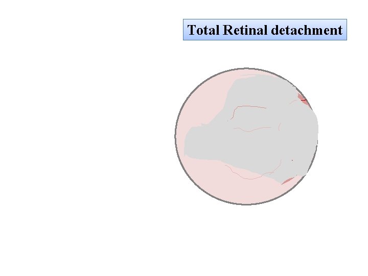 Total Retinal detachment 