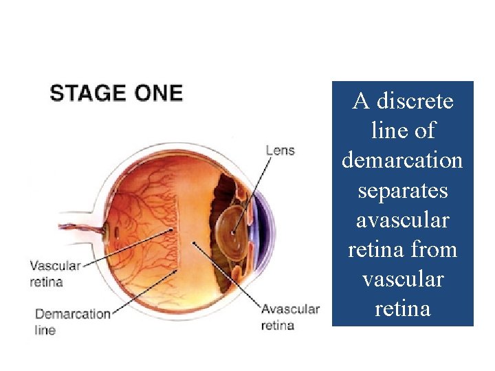 A discrete line of demarcation separates avascular retina from vascular retina 