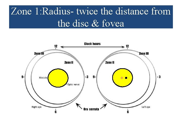 Zone 1: Radius- twice the distance from the disc & fovea 