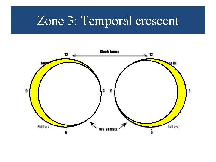 Zone 3: Temporal crescent 