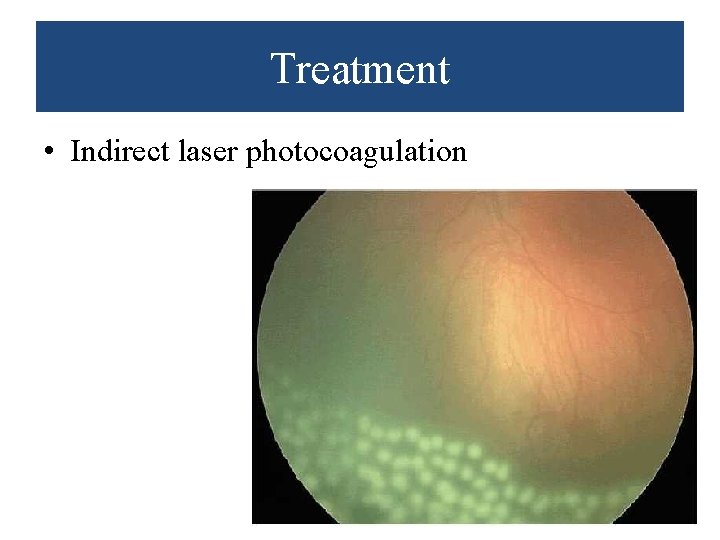 Treatment • Indirect laser photocoagulation 