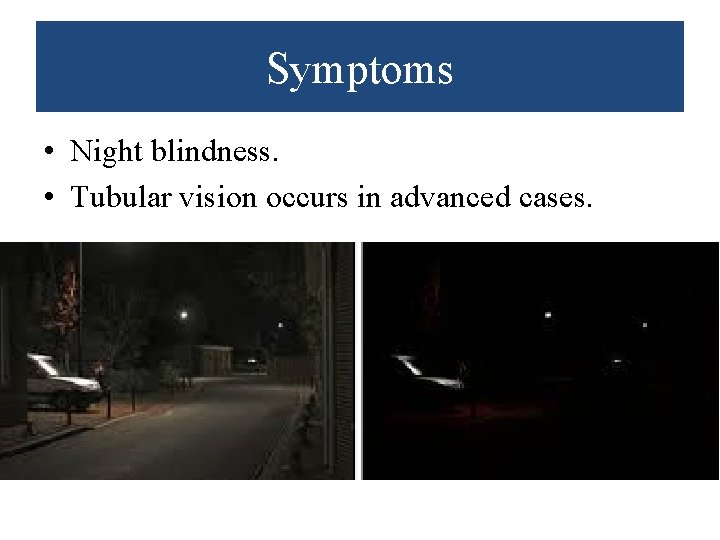 Symptoms • Night blindness. • Tubular vision occurs in advanced cases. 