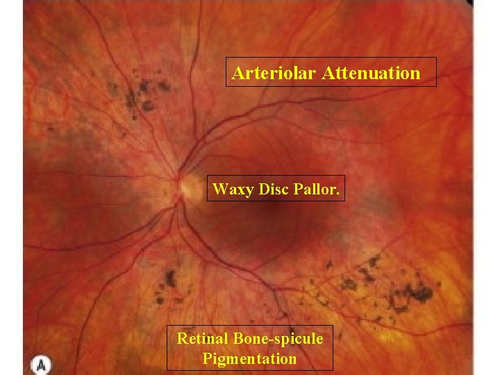 Arteriolar Attenuation Waxy Disc Pallor. Retinal Bone-spicule Pigmentation 