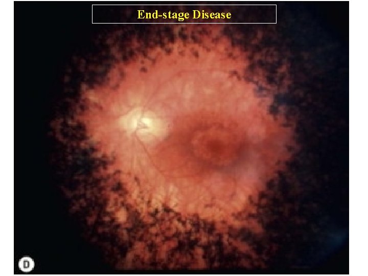 End-stage Disease 