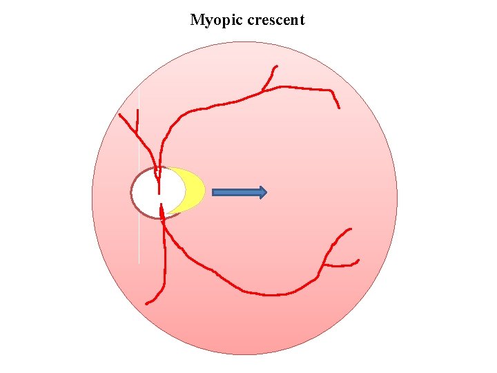 Myopic crescent 