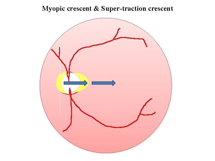 Myopic crescent & Super-traction crescent 