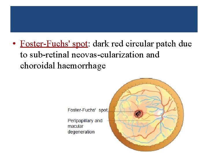  • Foster-Fuchs' spot: dark red circular patch due to sub-retinal neovas-cularization and choroidal