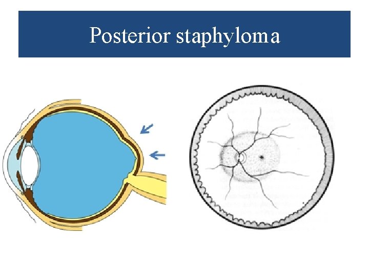 Posterior staphyloma 