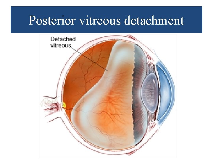 Posterior vitreous detachment 