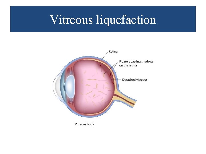 Vitreous liquefaction 