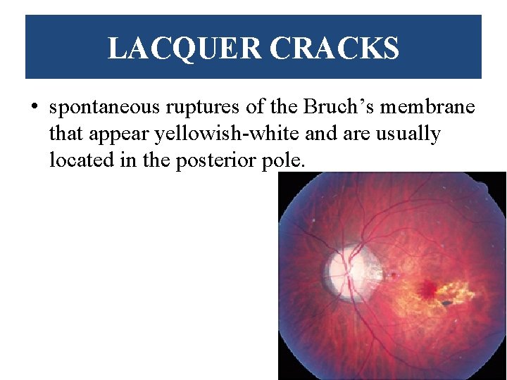 LACQUER CRACKS • spontaneous ruptures of the Bruch’s membrane that appear yellowish-white and are
