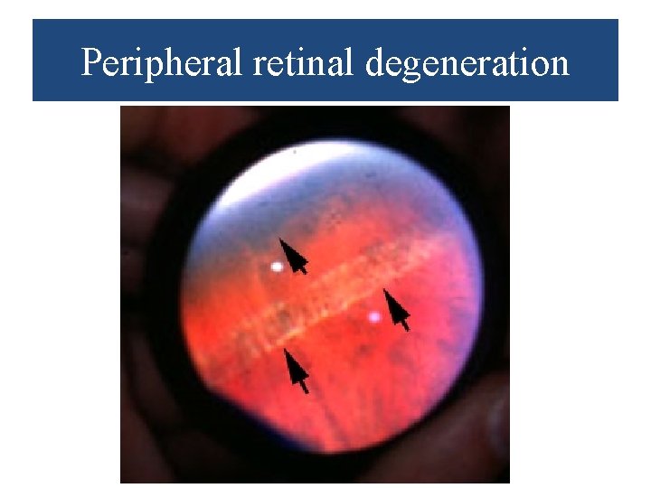 Peripheral retinal degeneration 