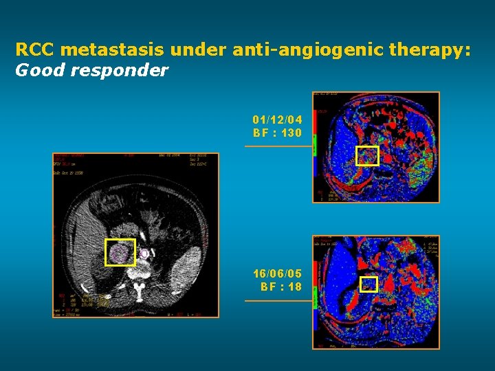 RCC metastasis under anti-angiogenic therapy: Good responder 01/12/04 BF : 130 16/06/05 BF :