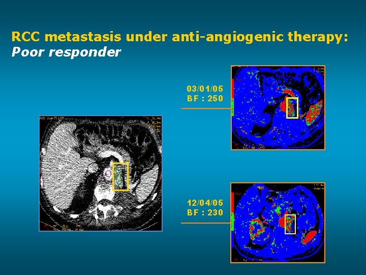 RCC metastasis under anti-angiogenic therapy: Poor responder 03/01/05 BF : 250 12/04/05 BF :