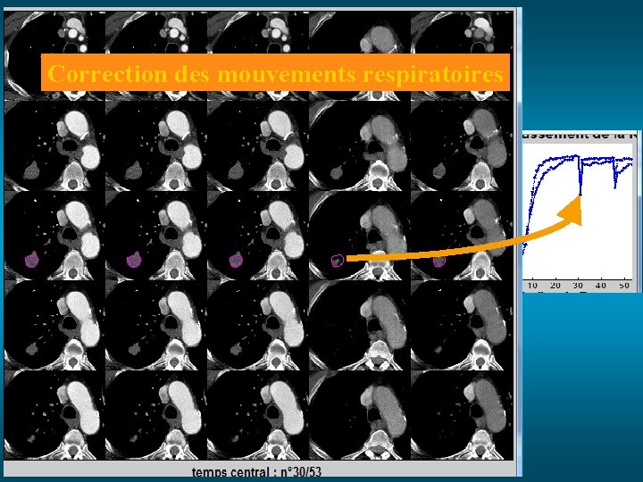 Correction des mouvements respiratoires 