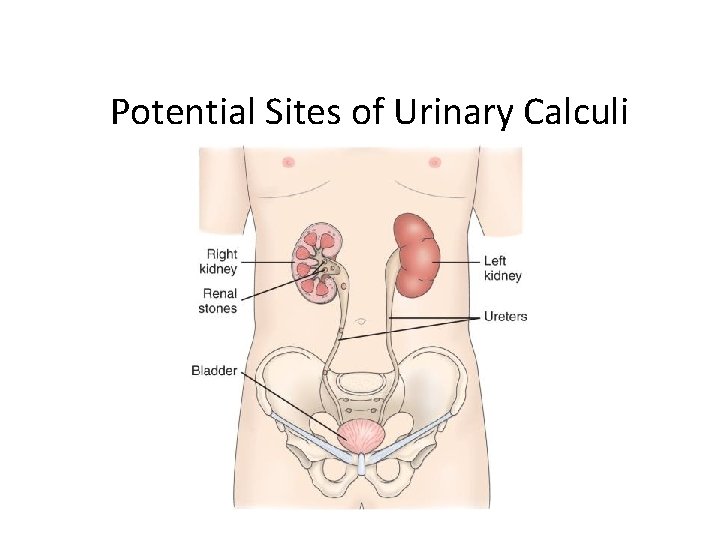 Potential Sites of Urinary Calculi 