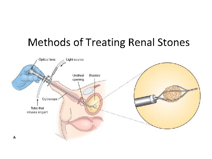 Methods of Treating Renal Stones 