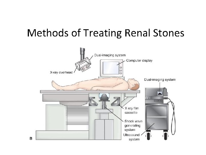 Methods of Treating Renal Stones 