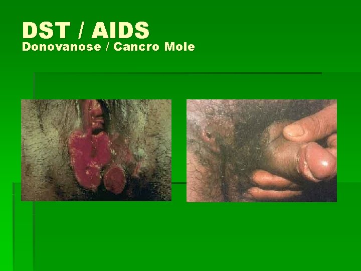 DST / AIDS Donovanose / Cancro Mole 
