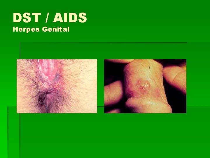DST / AIDS Herpes Genital 