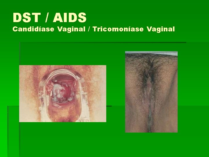 DST / AIDS Candidíase Vaginal / Tricomoníase Vaginal 