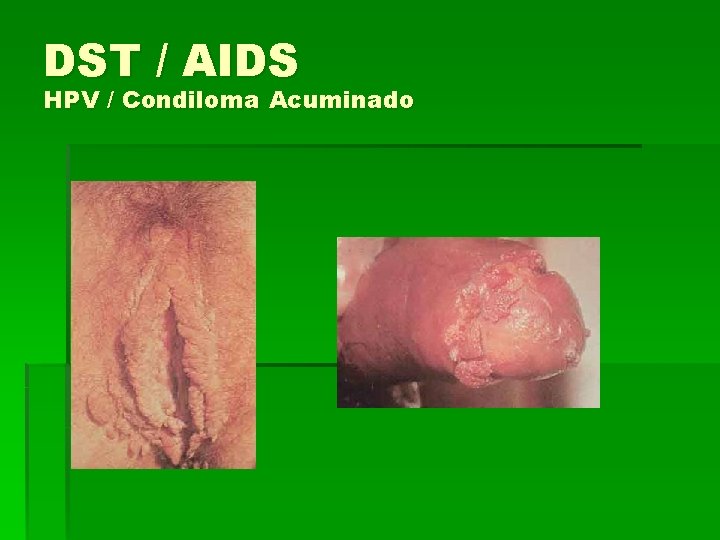 DST / AIDS HPV / Condiloma Acuminado 