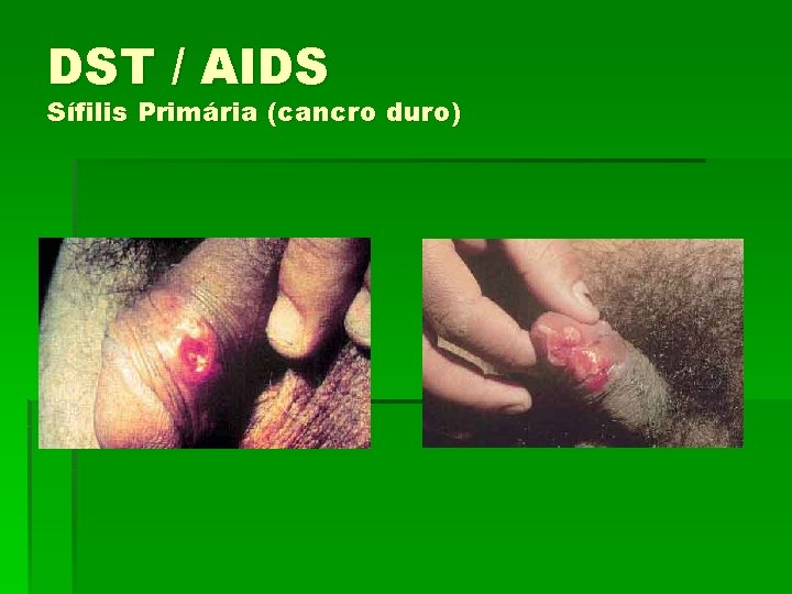 DST / AIDS Sífilis Primária (cancro duro) 