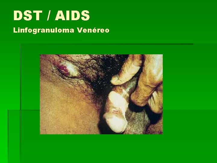 DST / AIDS Linfogranuloma Venéreo 