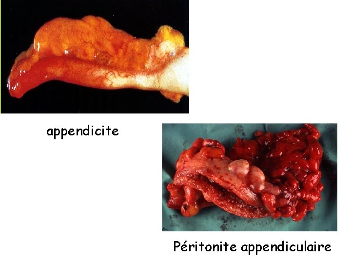 appendicite Péritonite appendiculaire 