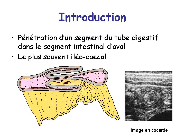 Introduction • Pénétration d’un segment du tube digestif dans le segment intestinal d’aval •