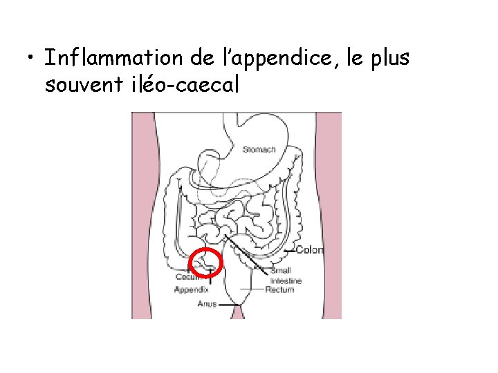  • Inflammation de l’appendice, le plus souvent iléo-caecal 