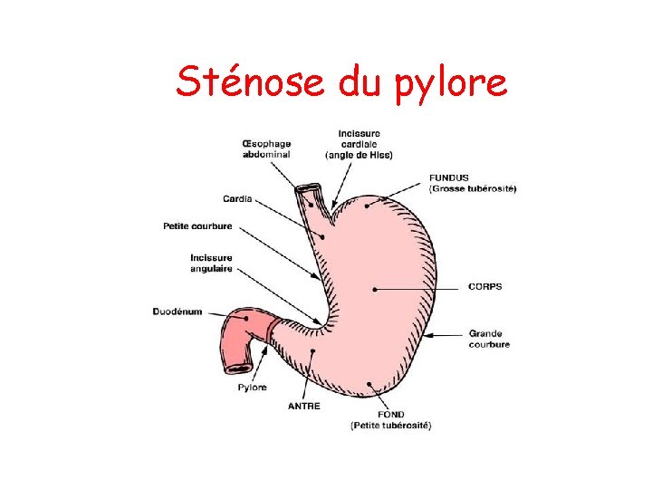 Sténose du pylore 