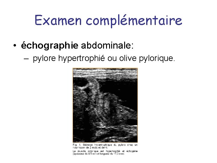 Examen complémentaire • échographie abdominale: – pylore hypertrophié ou olive pylorique. 