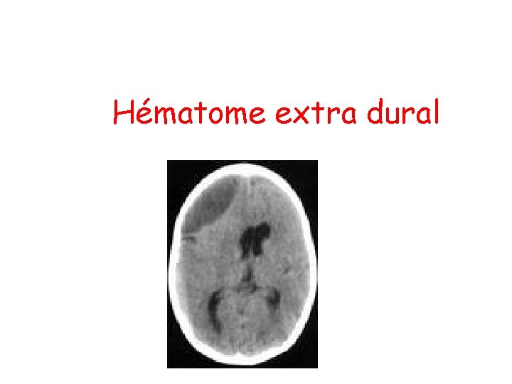 Hématome extra dural 