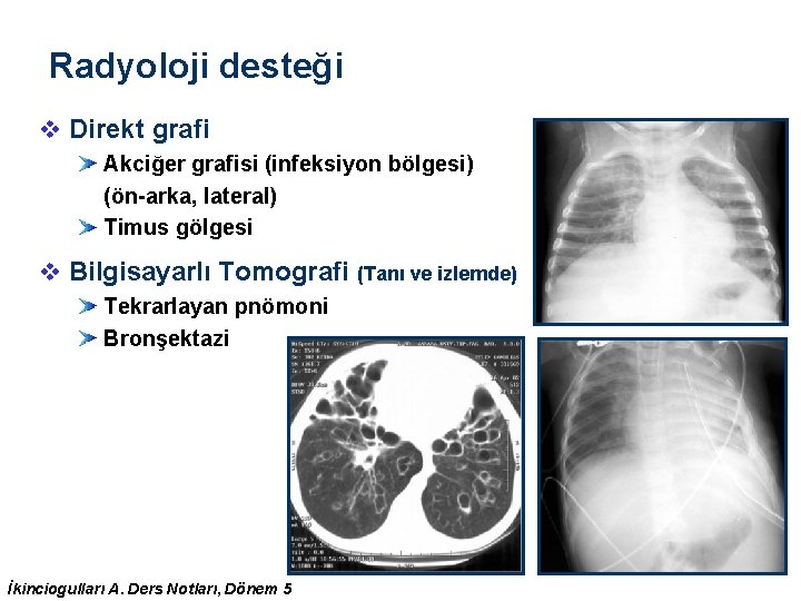 Radyoloji desteği v Direkt grafi Akciğer grafisi (infeksiyon bölgesi) (ön-arka, lateral) Timus gölgesi v Radyoloji desteği v Direkt grafi Akciğer grafisi (infeksiyon bölgesi) (ön-arka, lateral) Timus gölgesi v