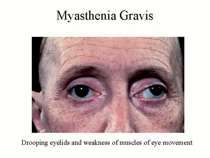 Myasthenia Gravis Drooping eyelids and weakness of muscles of eye movement 