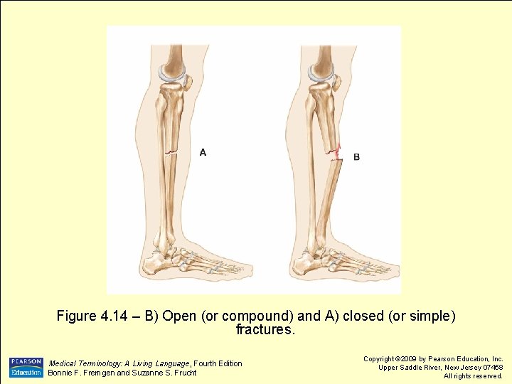 Figure 4. 14 – B) Open (or compound) and A) closed (or simple) fractures.