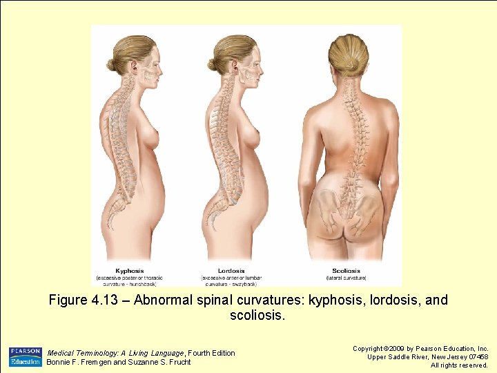 Figure 4. 13 – Abnormal spinal curvatures: kyphosis, lordosis, and scoliosis. Medical Terminology: A