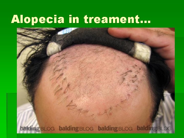 Alopecia in treament… 