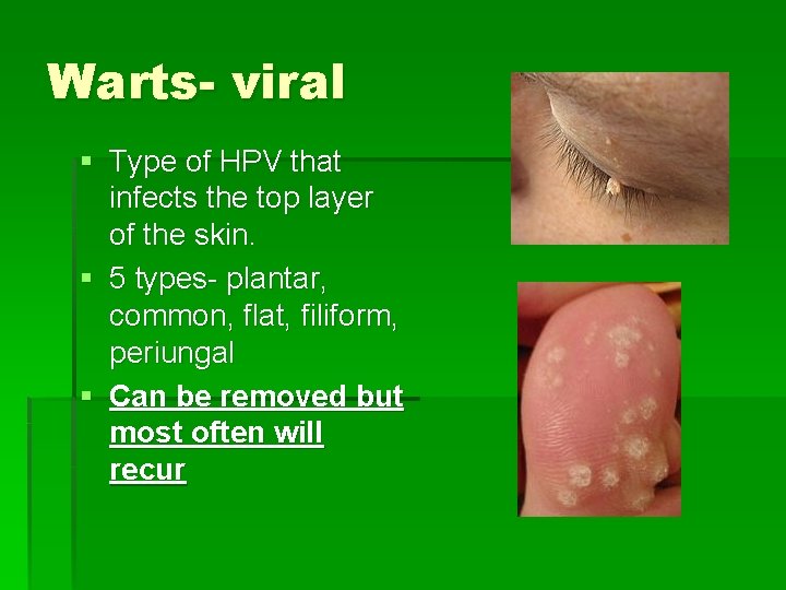 Warts- viral § Type of HPV that infects the top layer of the skin.